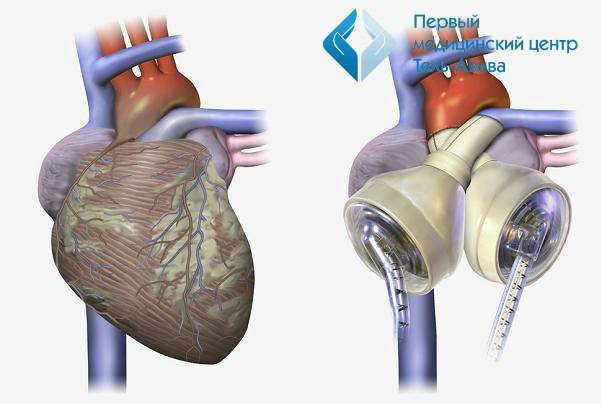 Успехи израильской кардиологии