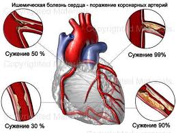 лечение ишемической болезни сердца в Израиле