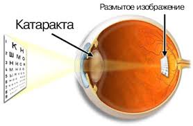 лечение катаракты в Израиле