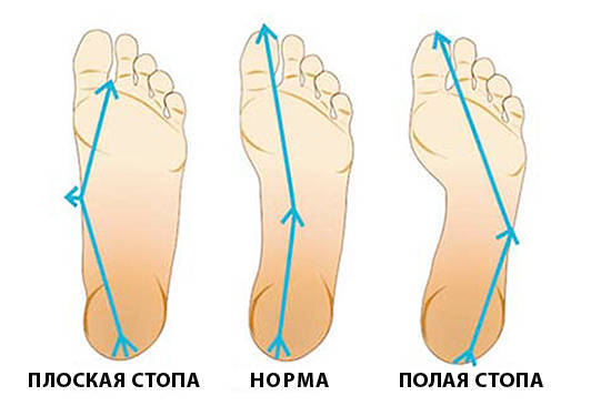 продольное плоскостопие