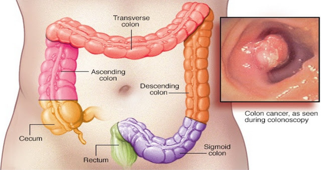 50-of-Colon-Cancer-Deaths-Could-Be-Avoided-if-Everyone-Did-These-10-Natural-Things-VIDEO